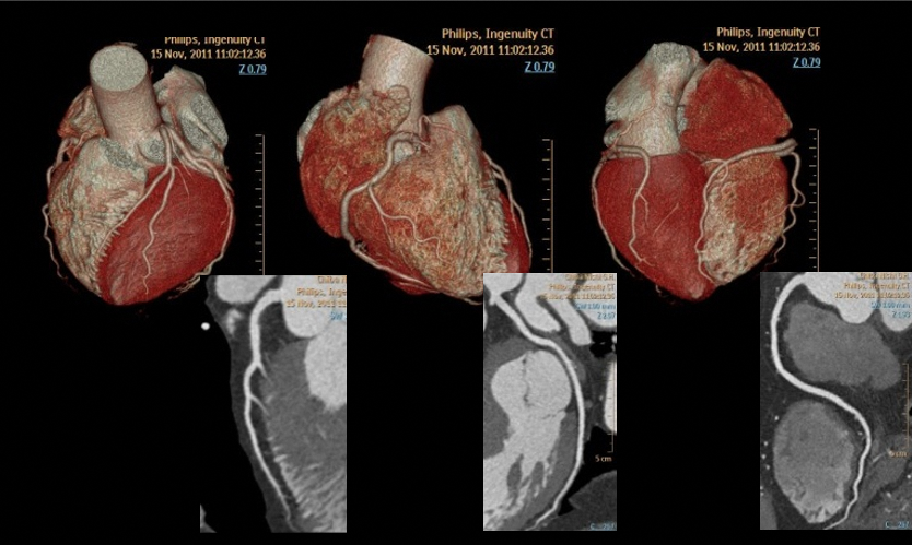 冠動脈（心臓）CT画像