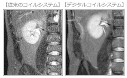 コイルシステム比較